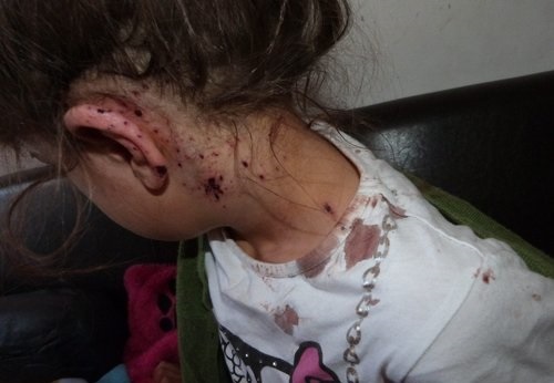  Une fillette de 6 ans a été bléssé au cou par des éclats reçus lors de perquisitions données par le RAID à Nice, jeudi matin dans le mauvais apartement.